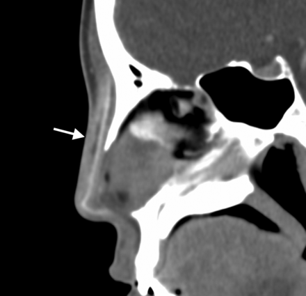 Fig 11.