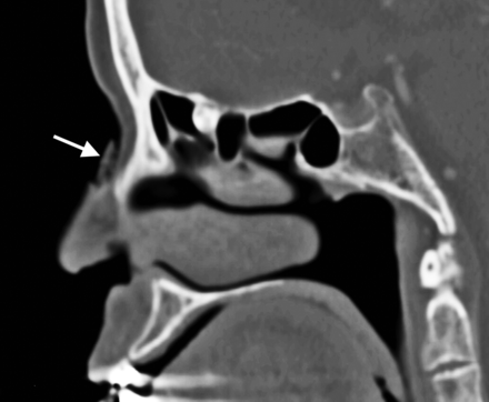 Fig 12.
